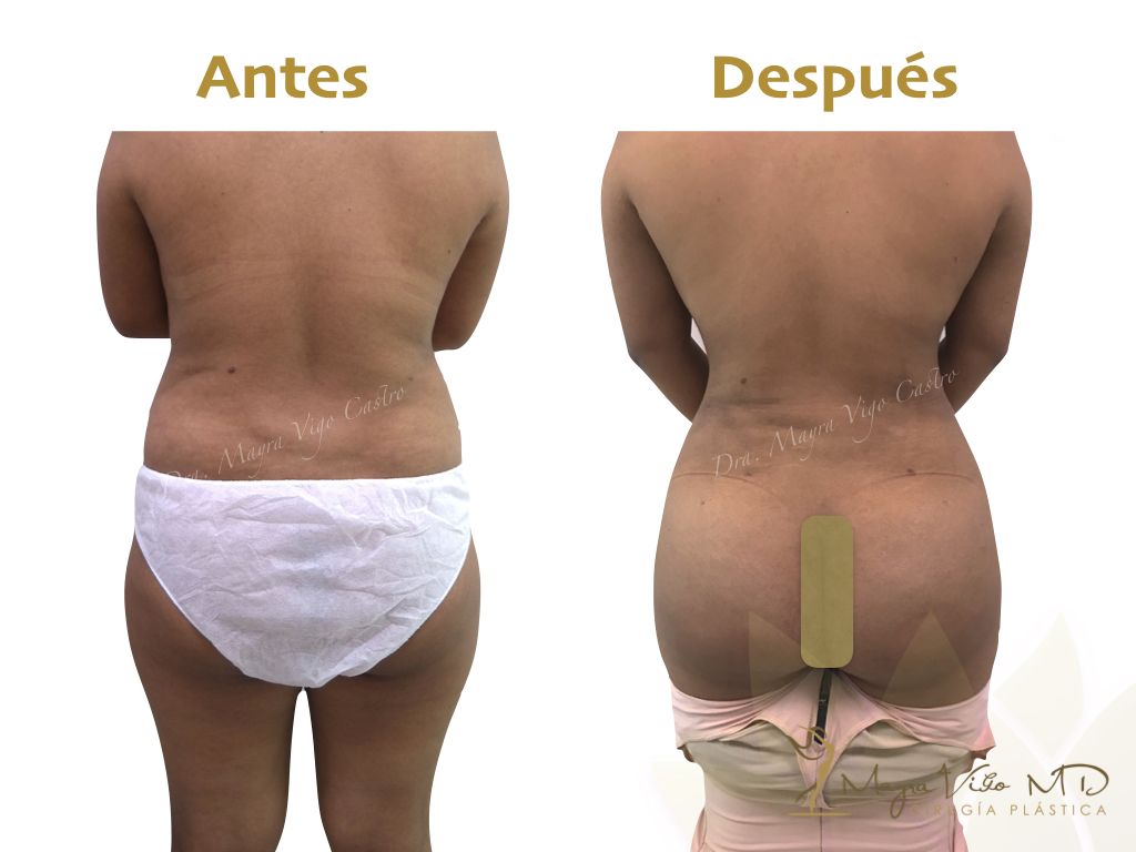Abdominoplastia y Miniabdominoplastia - Doctora Mayra Vigo